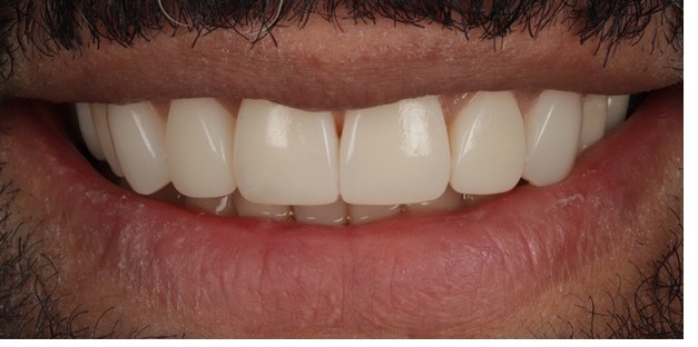 Case 2, full smile, after composite bonding treatment by Dr Pete