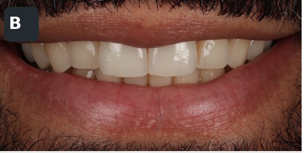 Case 2, full smile, before composite bonding treatment by Dr Pete