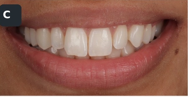Case 3, full smile, before composite bonding treatment by Dr Pete