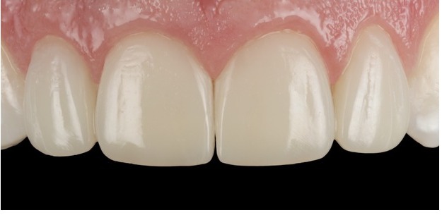 Case 4, anterior close-up, after composite bonding treatment by Dr Pete
