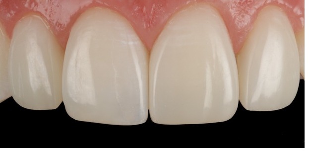 Case 5, central incisors, after composite bonding treatment by Dr Pete