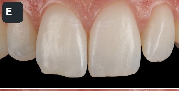 Case 5, central incisors, before composite bonding treatment by Dr Pete