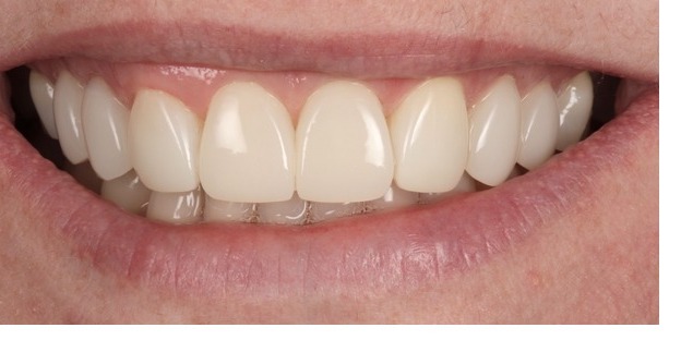Case 6, full smile, after composite bonding treatment by Dr Pete