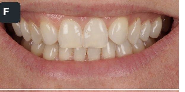 Case 6, full smile, before composite bonding treatment by Dr Pete